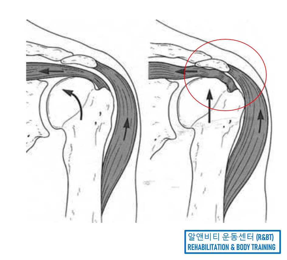 어깨 수술 후 재활 블로그 글 대표 이미지